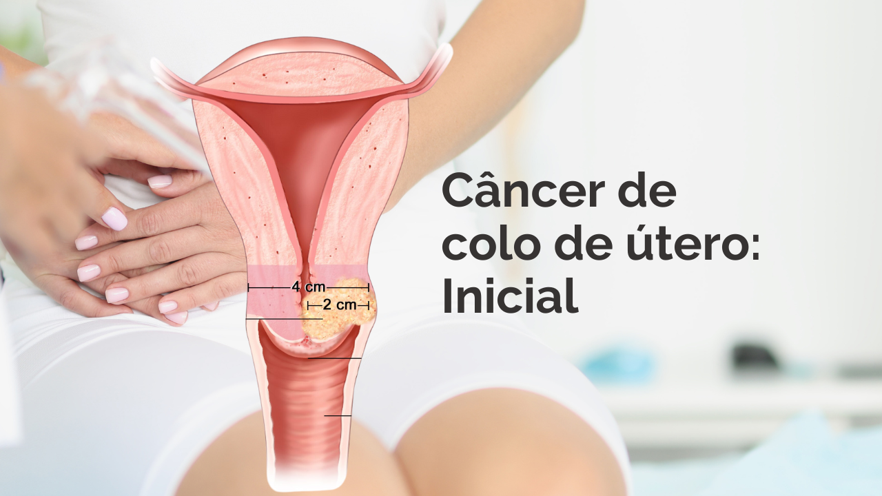 Tratamento do Câncer de Colo de Útero Inicial: O que Você Precisa Saber