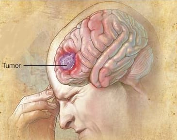 Glioblastoma tem cura?
