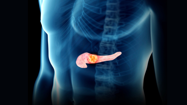 Câncer de Pâncreas: Confrontando os Seus Desafios e Entendendo os Fatores de Risco